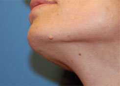 Skin Lesion Before & After Photo