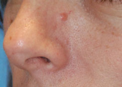 Skin Lesion Before & After Photo