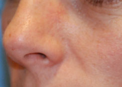 Skin Lesion Before & After Photo