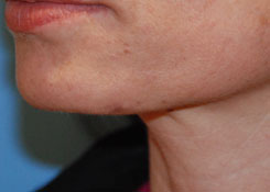 Skin Lesion Before & After Photo