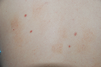 Skin Lesion Before & After Photo