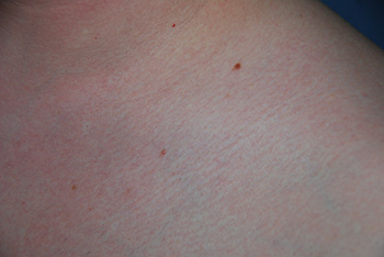 Skin Lesion Before & After Photo