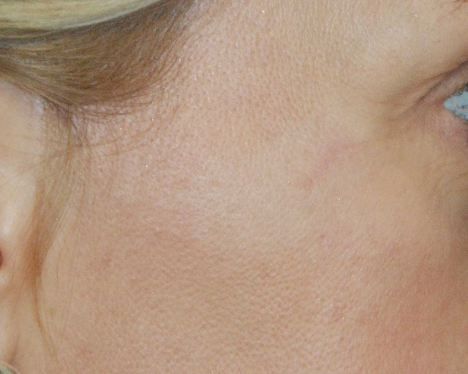 Skin Lesion Before & After Photo