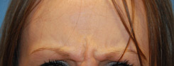 Botox® Before & After Photo