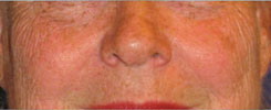 Laser Resurfacing Before & After Photo