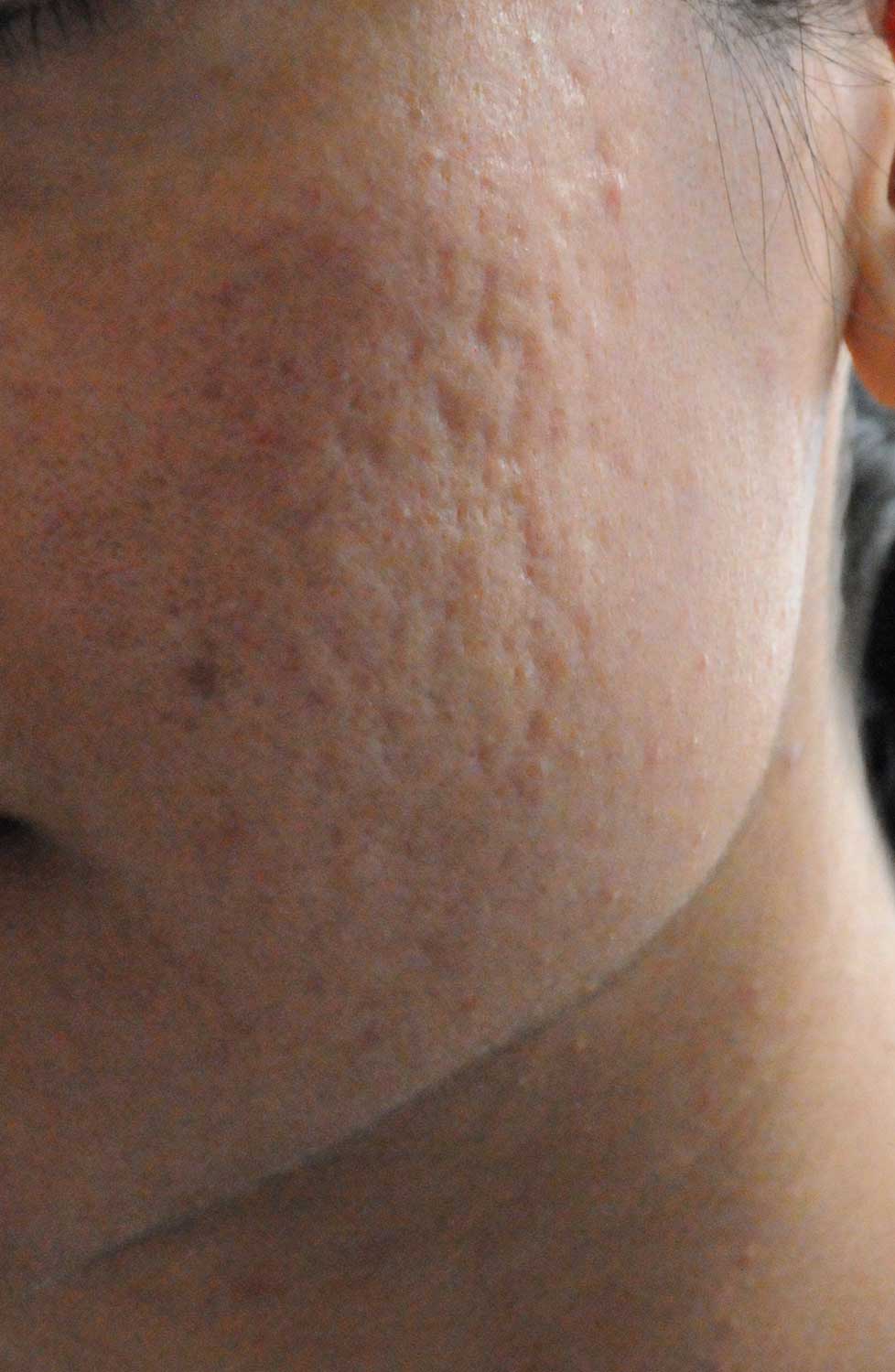 Acne Scar Vitalizer Before Treatment