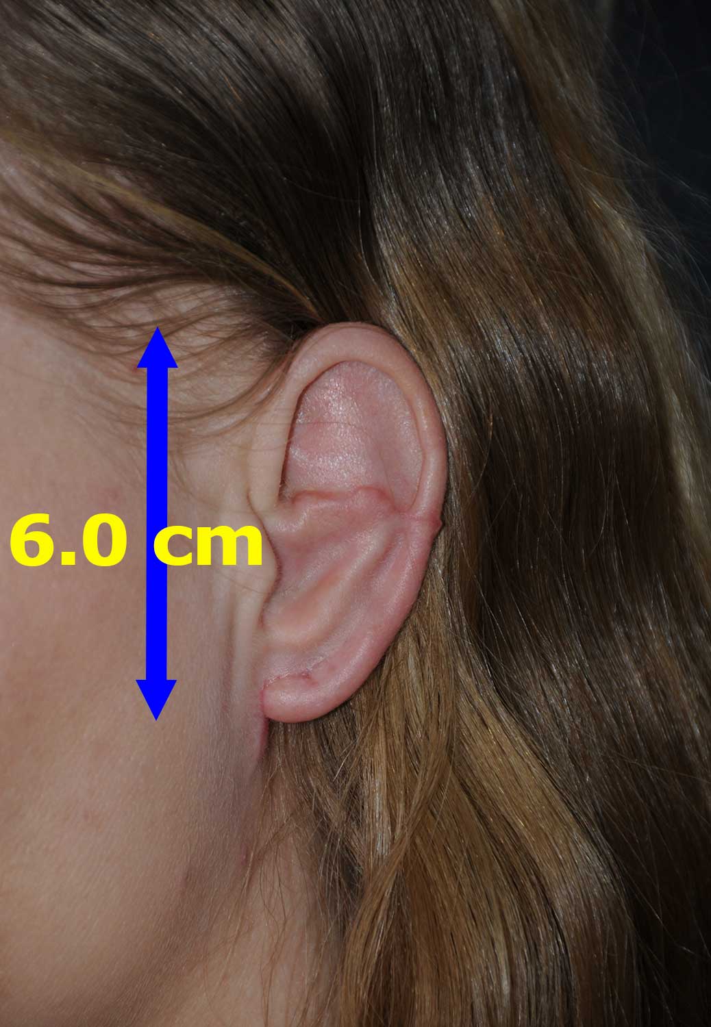  Macrotia Left Ear Oblique View After Large Ear Macrotia Reduction & Prominent Ear Pinning Otoplasty 