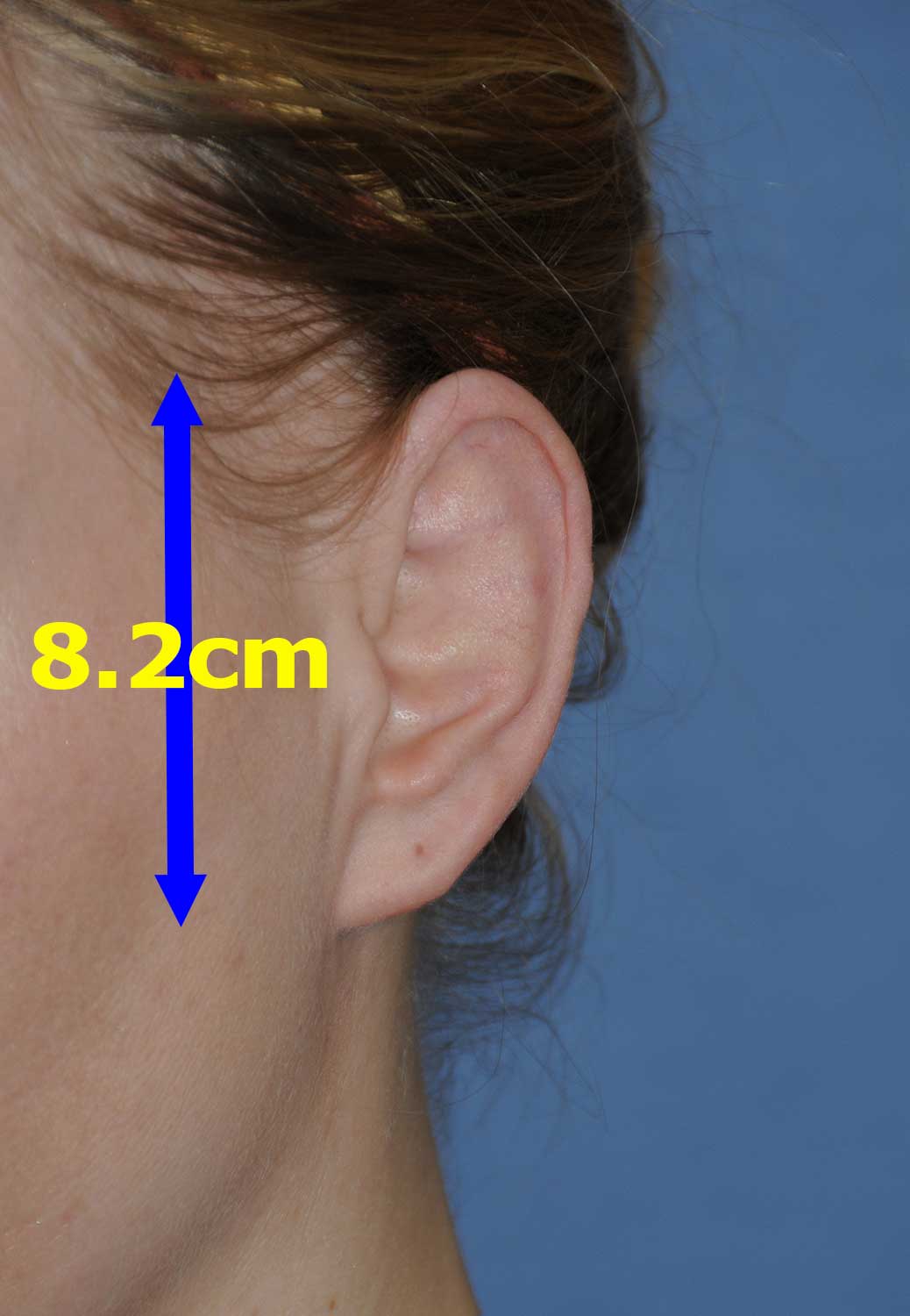 Macrotia Left Ear Oblique View Before Large Ear Macrotia Reduction & Prominent Ear Pinning Otoplasty