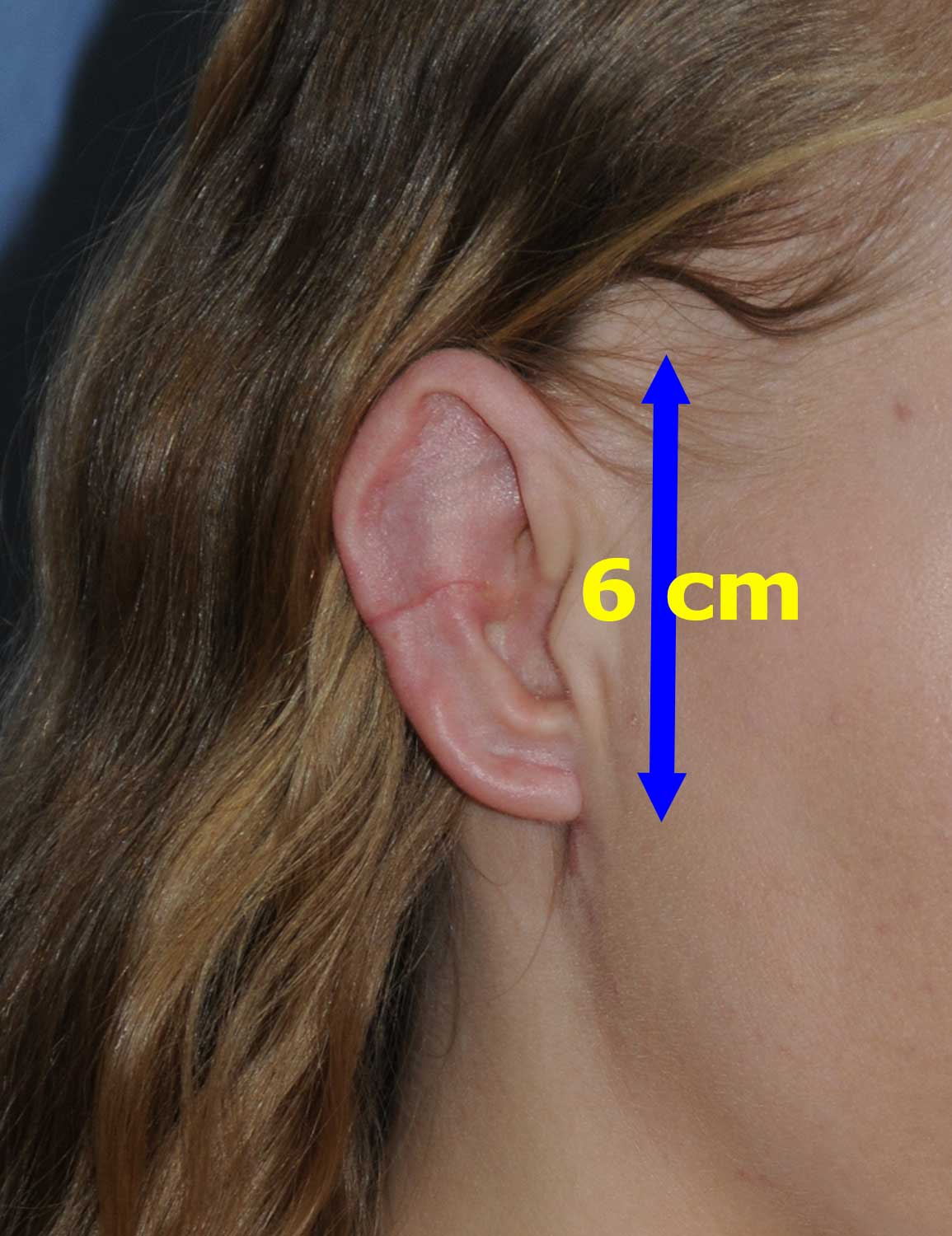 Macrotia Right Ear Oblique View After Large Ear Macrotia Reduction & Prominent Ear Pinning Otoplasty 