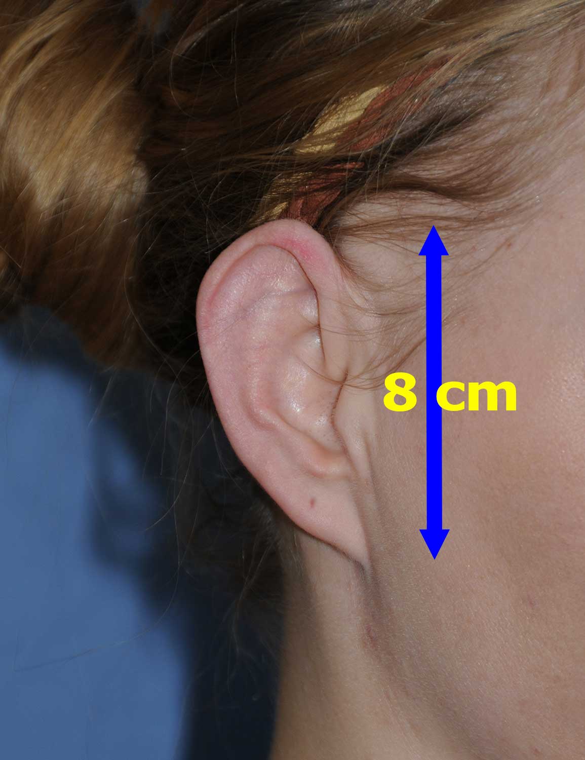 Macrotia Right Ear Oblique View Before Large Ear Macrotia Reduction & Prominent Ear Pinning Otoplasty 