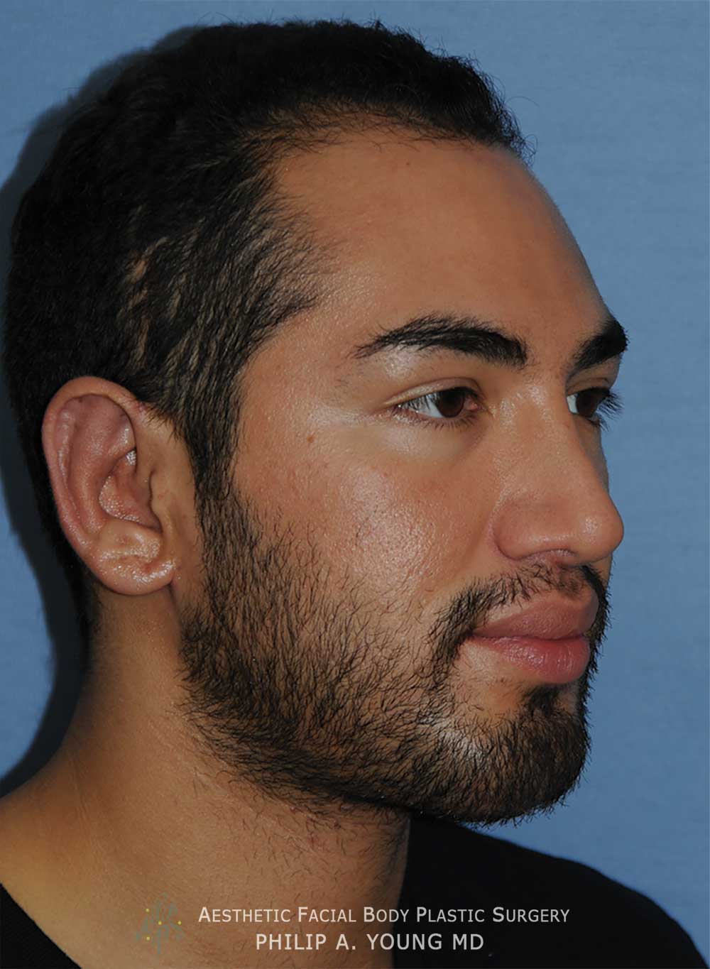 After Otoplasty | Ear Reshaping Chin Implant for Prominent Ears, Retruded & Small Chin Right Oblique
