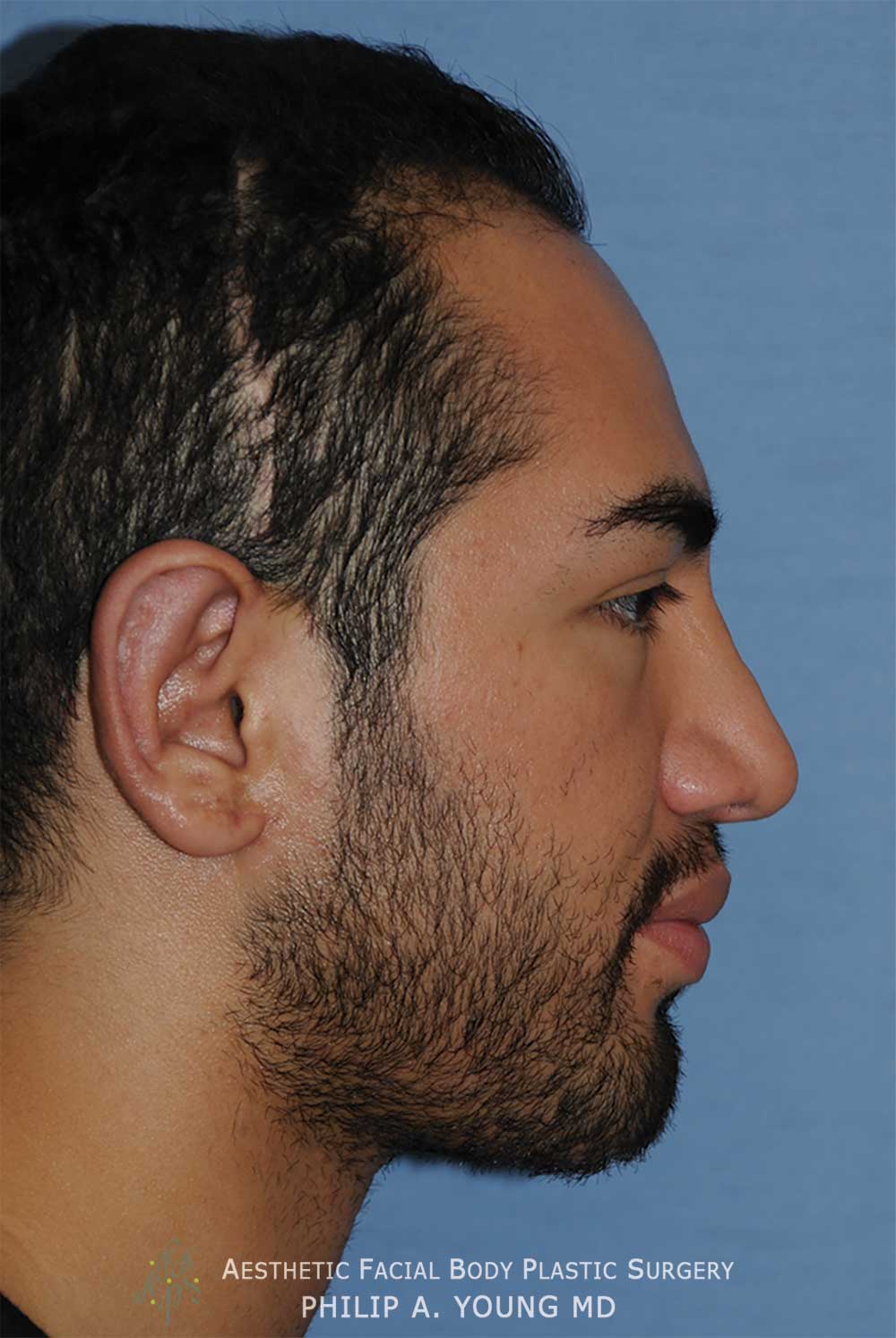 After Otoplasty | Ear Reshaping Chin Implant for Prominent Ears, Retruded & Small Chin Right Side Image