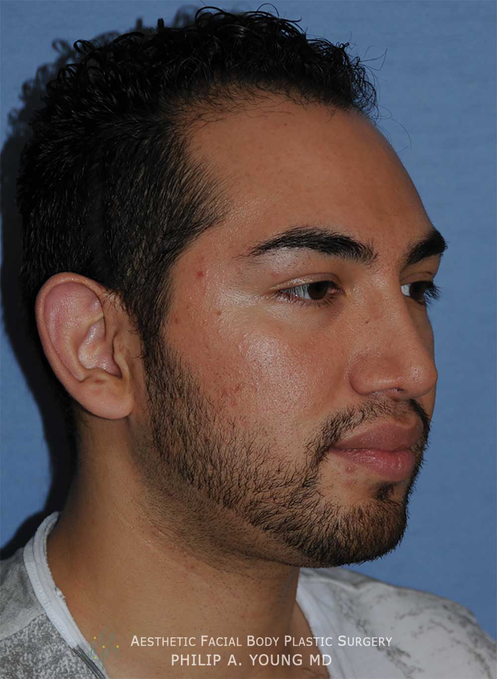 Before Otoplasty | Ear Reshaping Chin Implant for Prominent Ears, Retruded & Small Chin Right Oblique