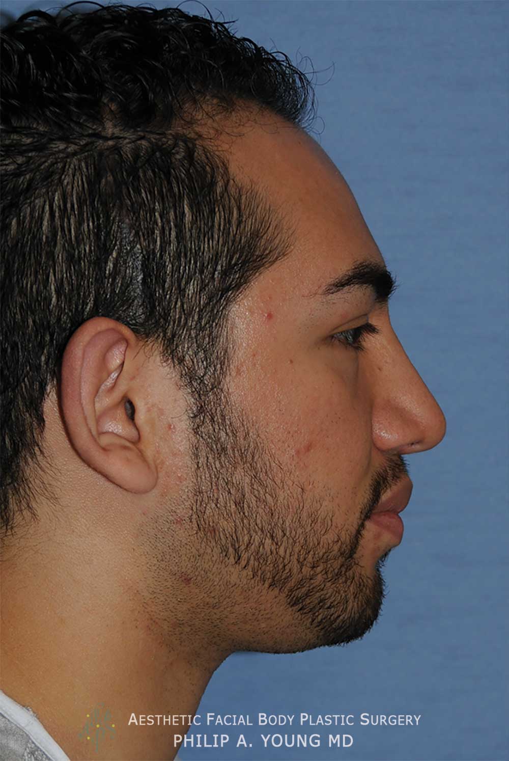 Before Otoplasty | Ear Reshaping Chin Implant for Prominent Ears, Retruded & Small Chin Right Side Image
