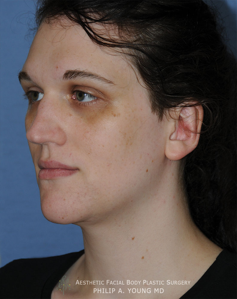 After Transgender Facial Feminization Otoplasty & Chin Reduction Procedure Oblique View