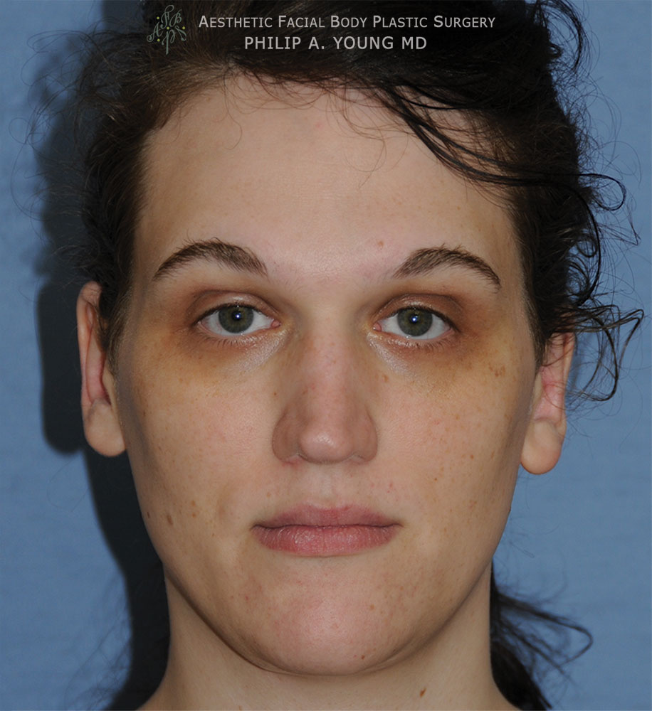 After Transgender Facial Feminization Otoplasty & Chin Reduction Procedure Front View