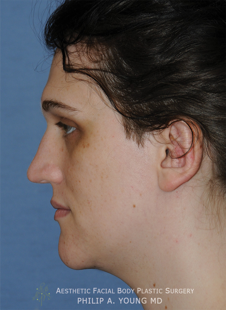 After Transgender Facial Feminization Otoplasty & Chin Reduction Procedure Side View