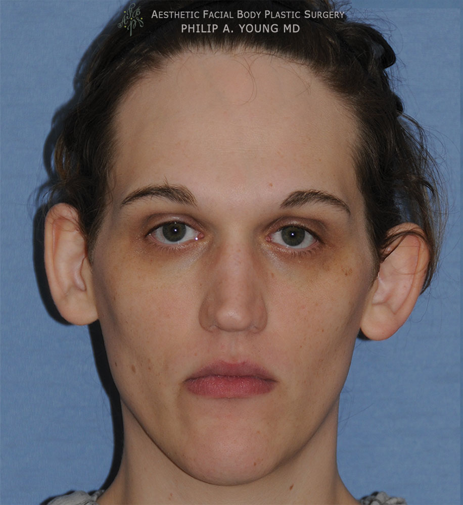 Before Transgender Facial Feminization Otoplasty & Chin Reduction Procedure Front Before View