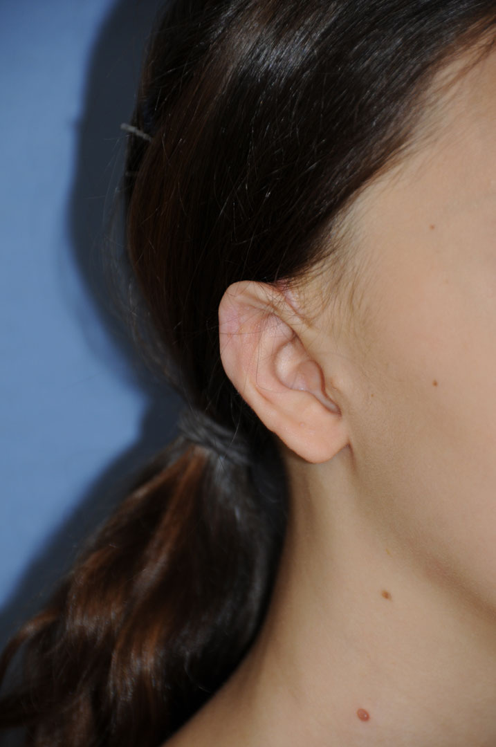 Cup Lop Constricted Ear After Otoplasty Oblique