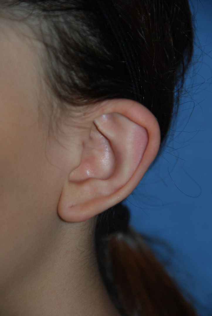 Cup Lop Constricted Ear Before Otoplasty Left Oblique Close up