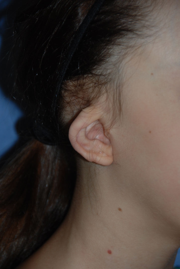 Cup Lop Constricted Ear Before Otoplasty Oblique