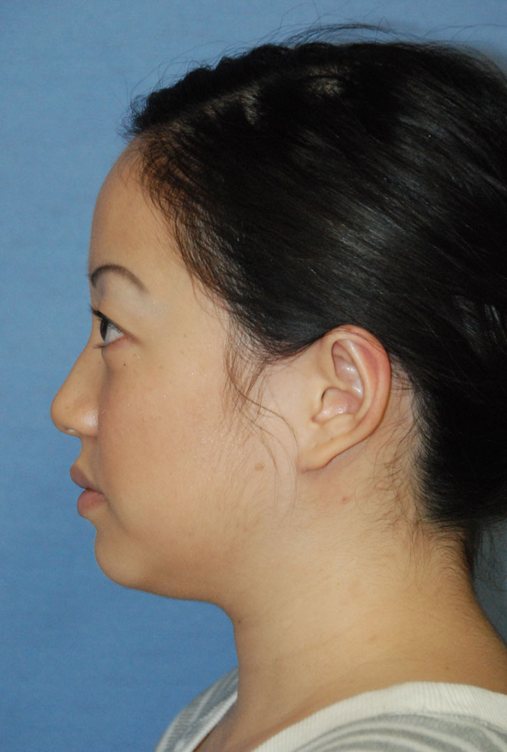 after side view otoplasty big protruding ears asian female patient