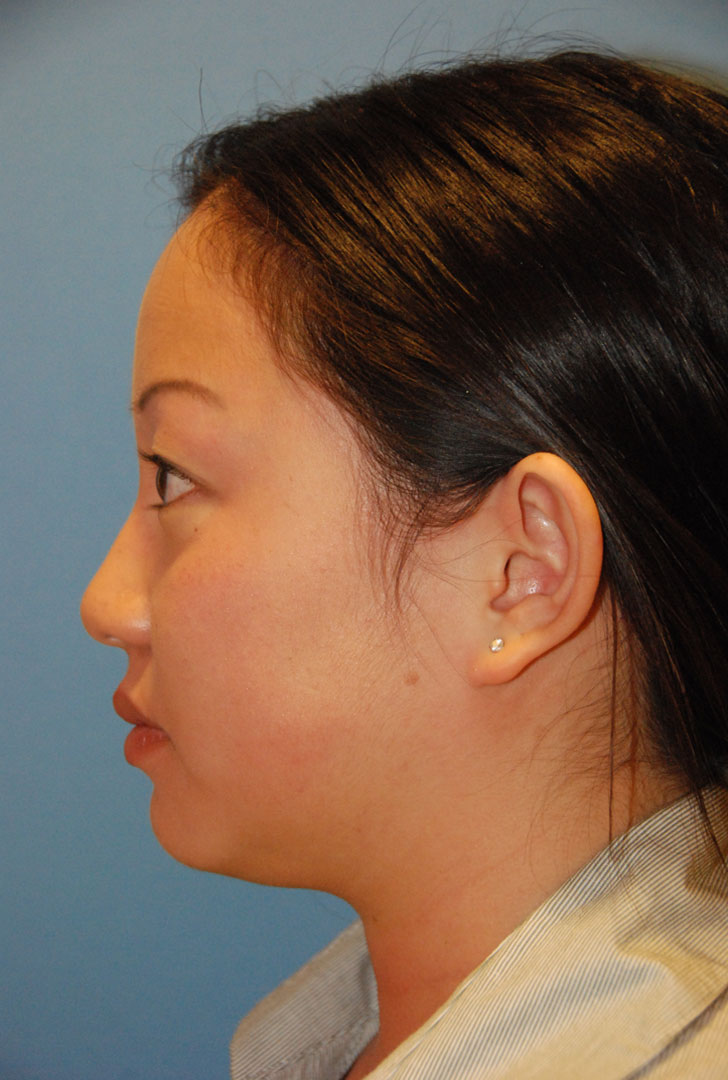 before side view otoplasty big protruding ears asian female patient