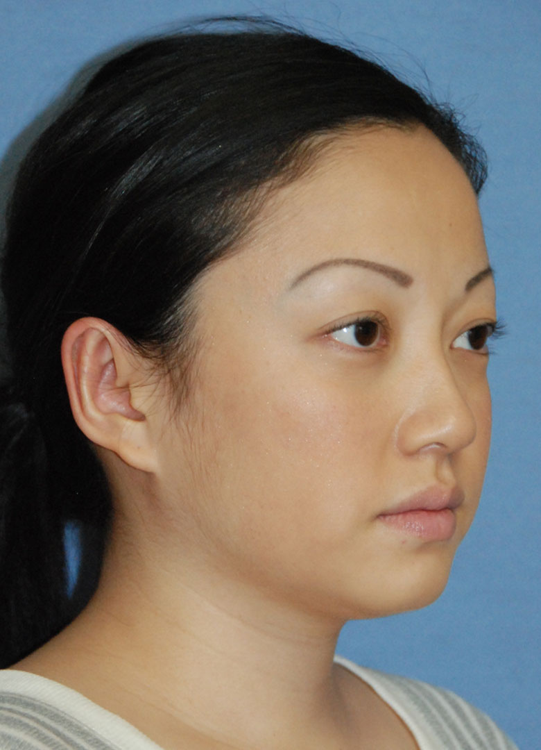after oblique view otoplasty big protruding ears asian female patient