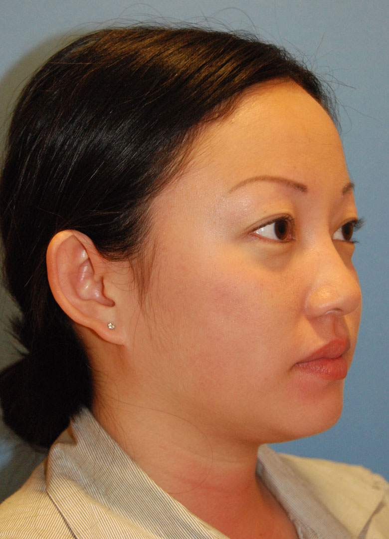 before oblique view otoplasty big protruding ears asian female patient