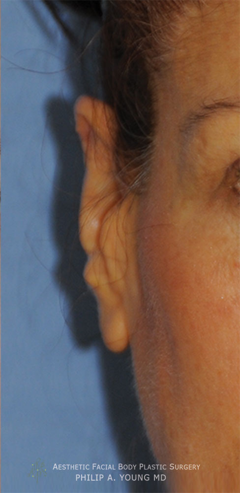 Otoplasty Revision for Macrotia Large Ears and Earlobe Repinning After