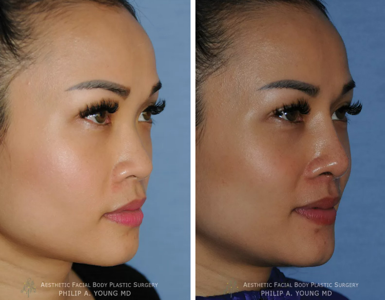 Ethnic rhinoplasty before & after case 01