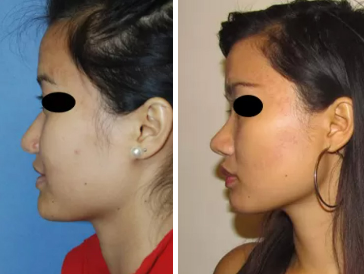 Ethnic rhinoplasty before & after case 02
