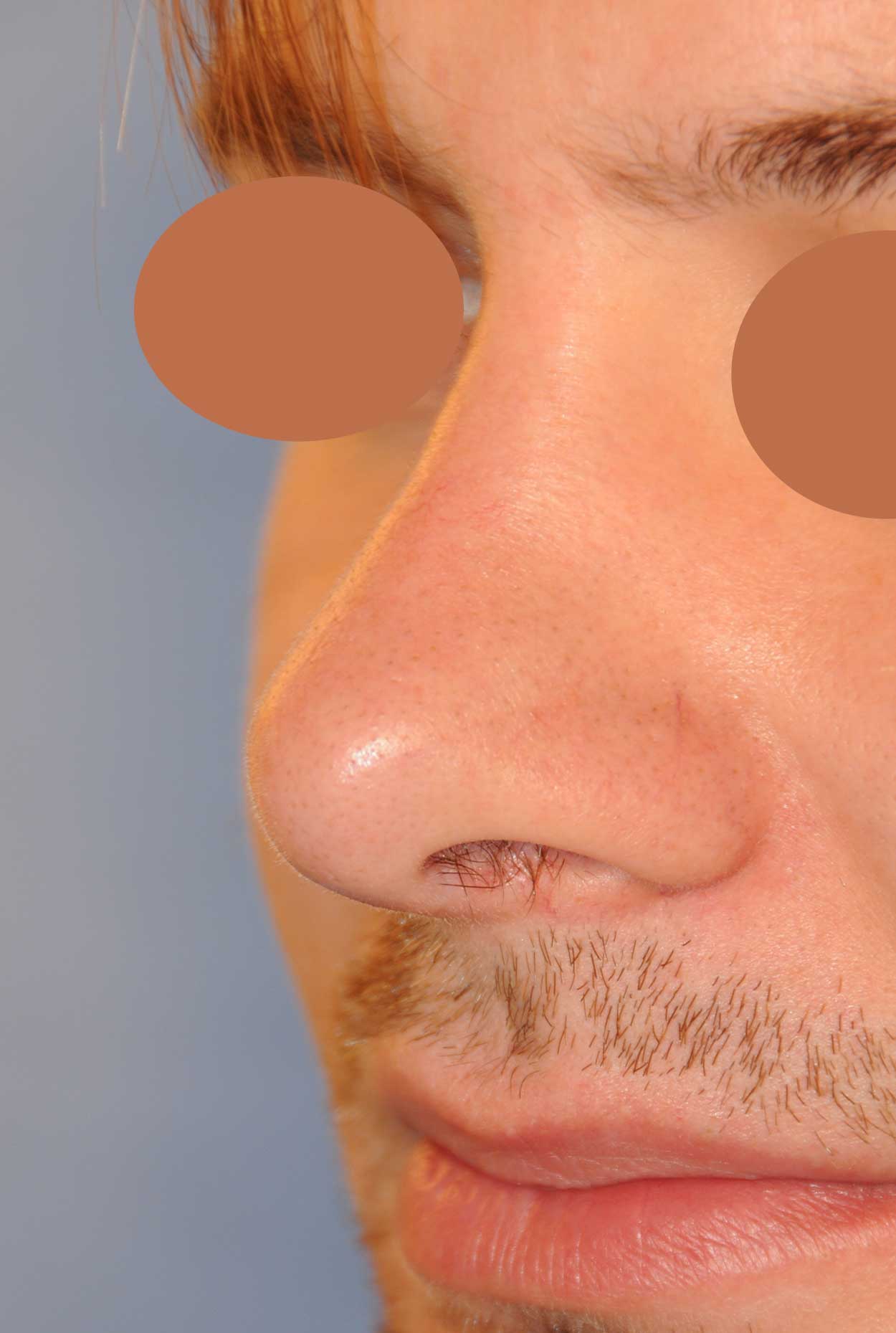 Rhinoplasty for a Crooked Nose, Large Nasal Bridge Hump and Bulbous Overly Projected Nasal Tip
After Left Oblique View