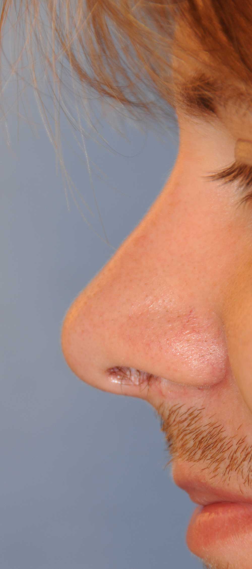 Rhinoplasty for a Crooked Nose, Large Nasal Bridge Hump and Bulbous Overly Projected Nasal Tip
After Profile View