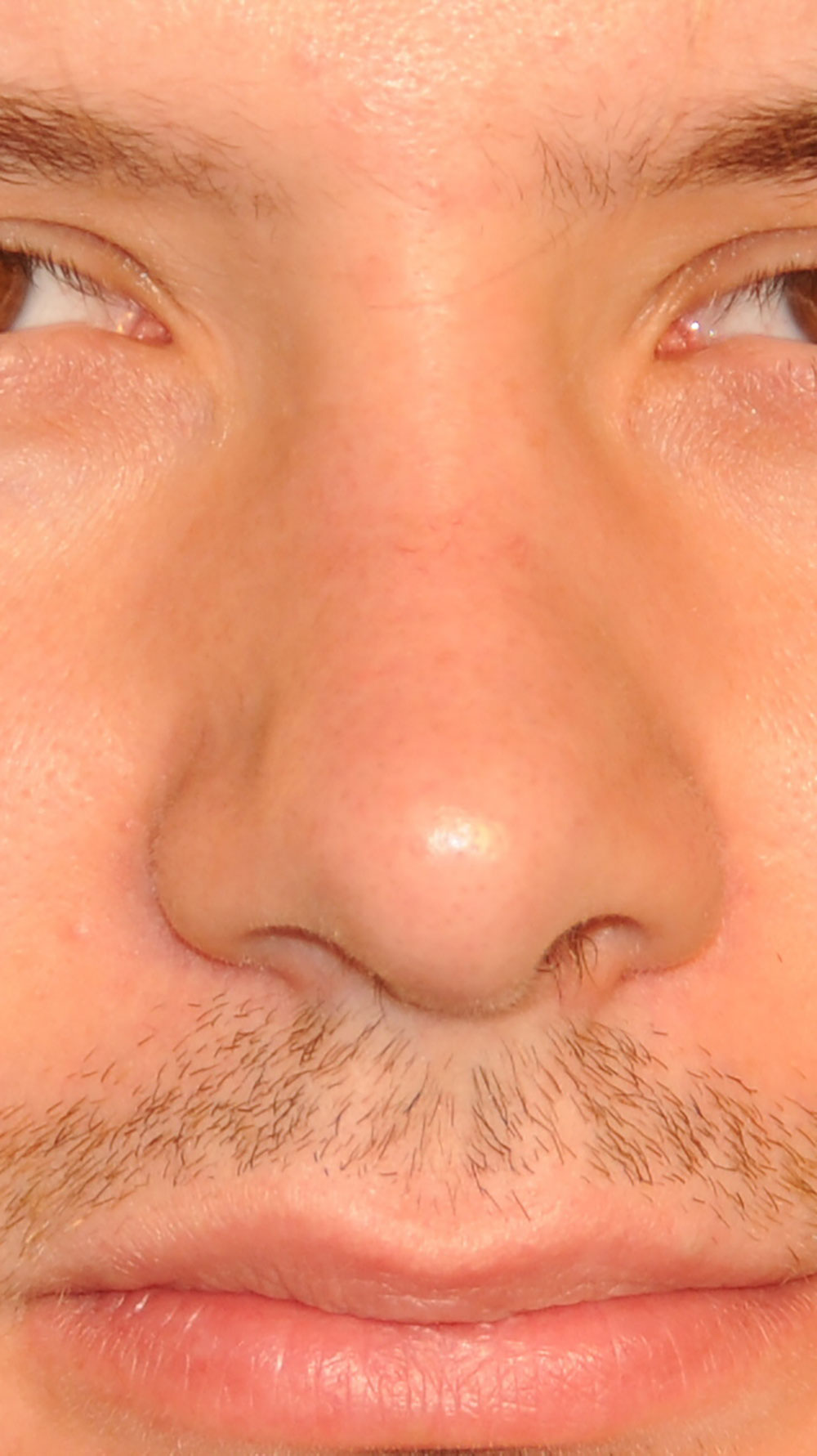 Rhinoplasty for a Crooked Nose, Large Nasal Bridge Hump and Bulbous Overly Projected Nasal Tip After