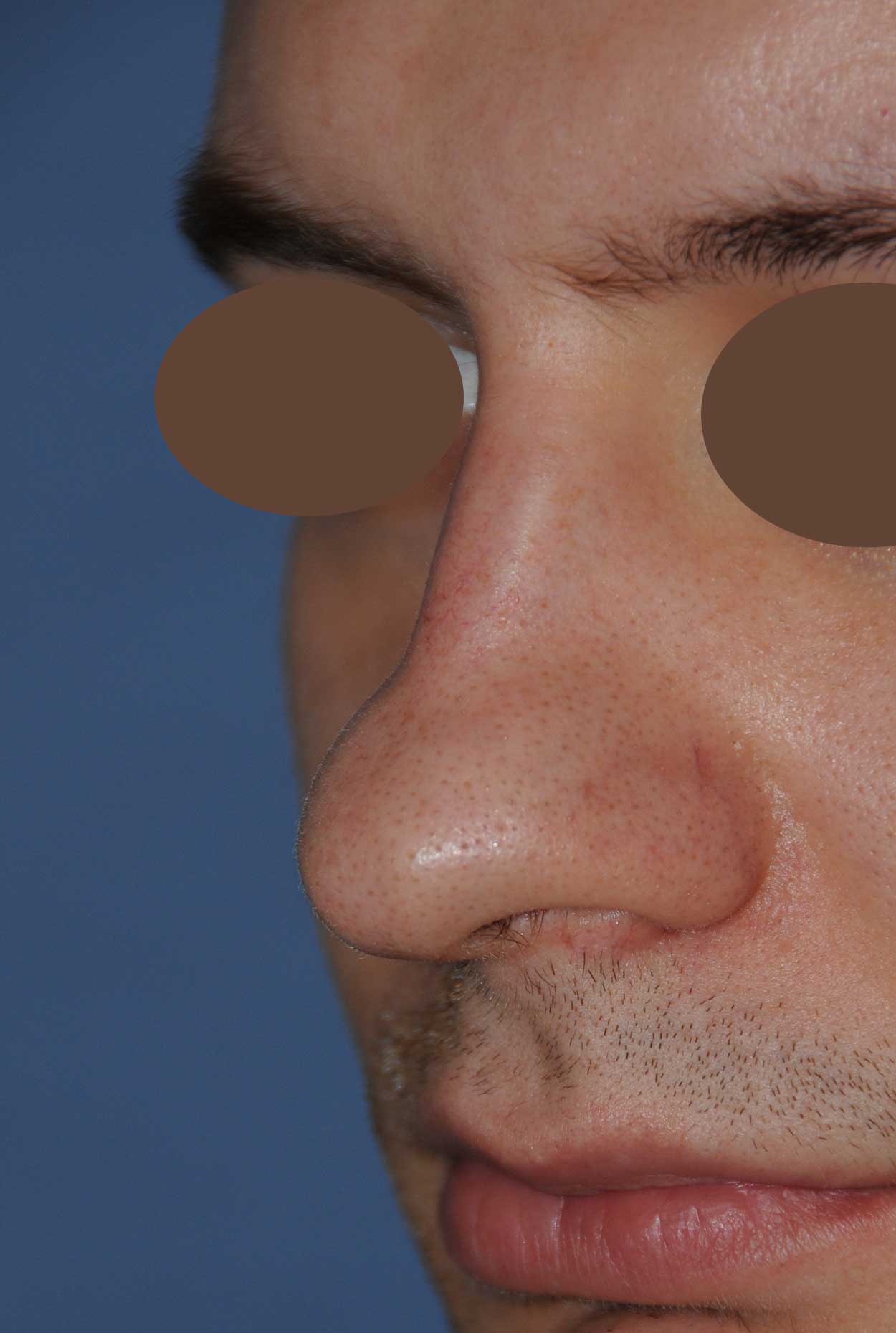Rhinoplasty for a Crooked Nose, Large Nasal Bridge Hump and Bulbous Overly Projected Nasal Tip Before Left Oblique View