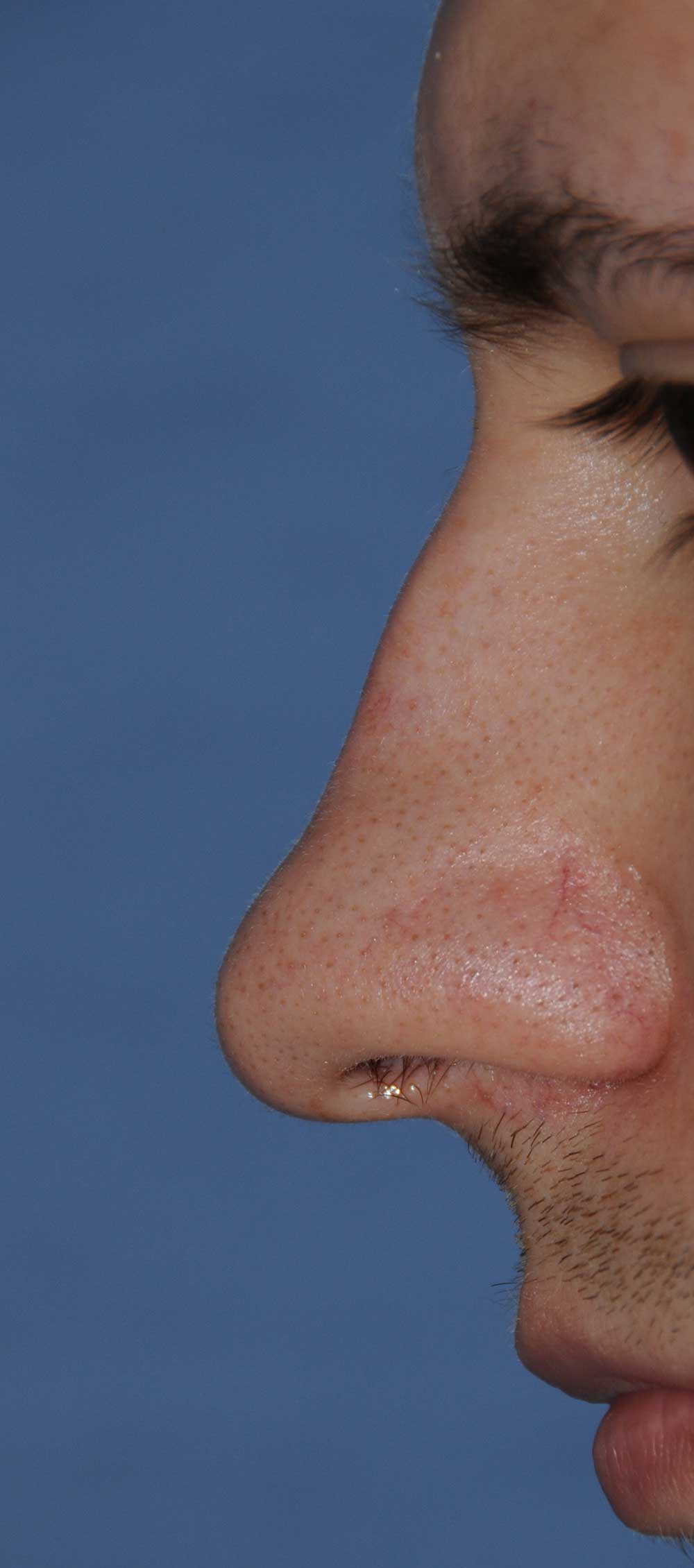 Rhinoplasty for a Crooked Nose, Large Nasal Bridge Hump and Bulbous Overly Projected Nasal Tip Before Profile View
