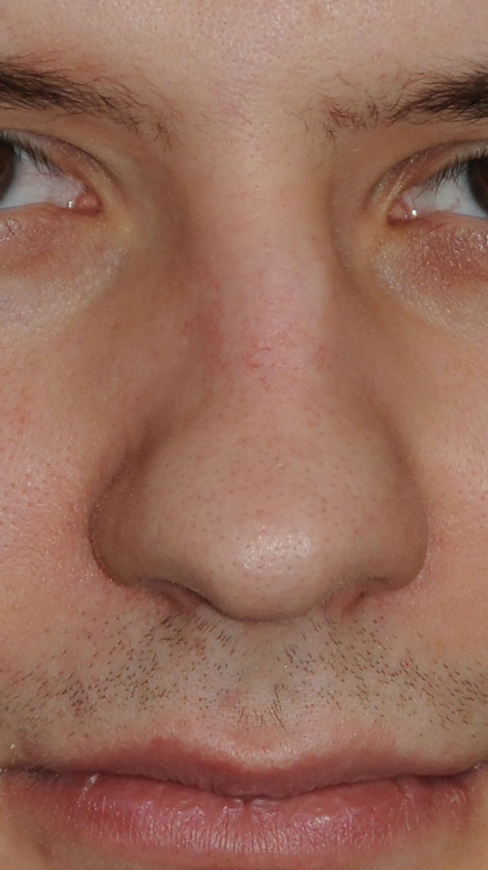 Rhinoplasty for a Crooked Nose, Large Nasal Bridge Hump and Bulbous Overly Projected Nasal Tip Before