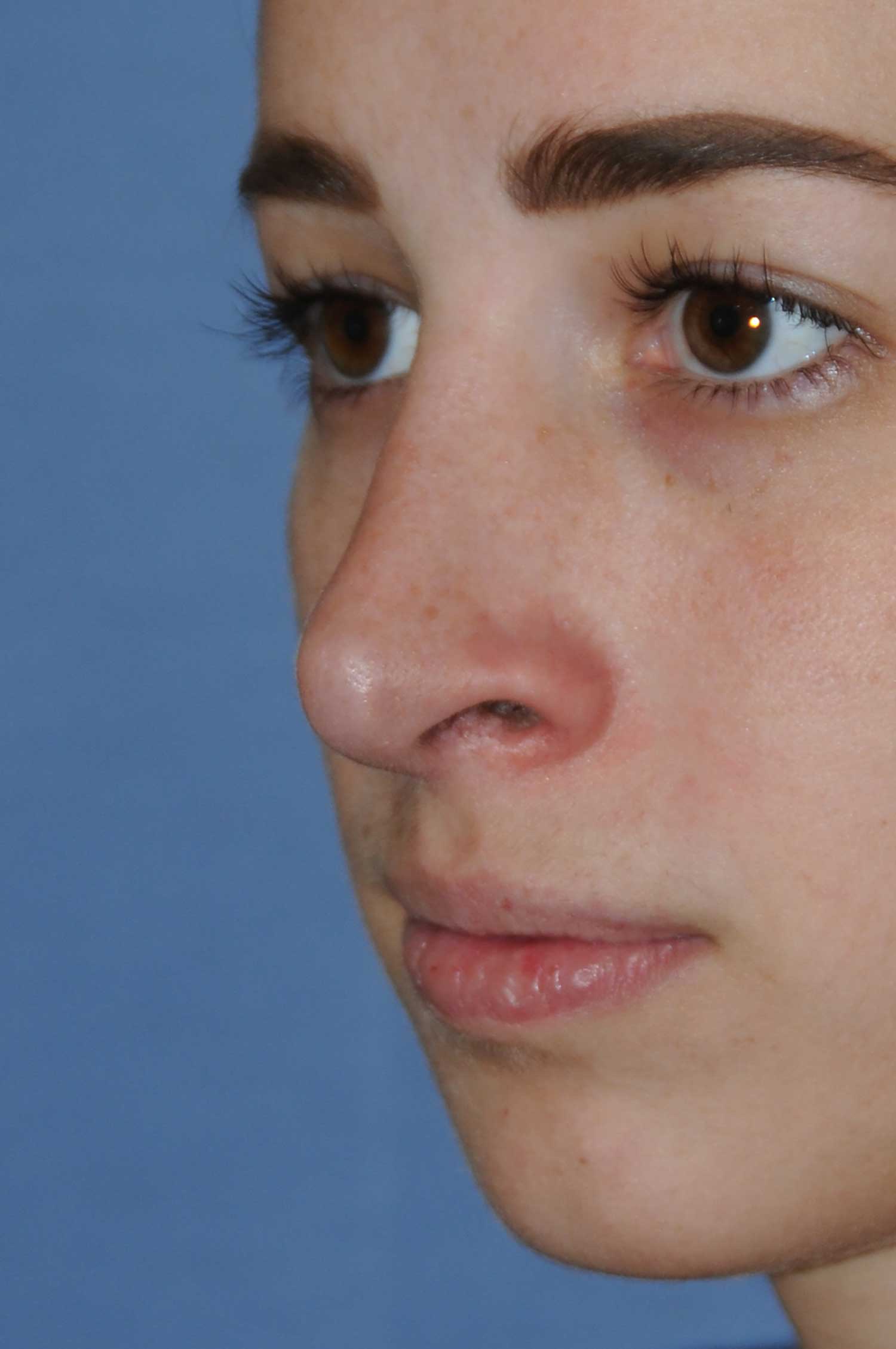 After Rhinoplasty for a Nasal Bridge Hump Bump, Large Hook Nose Left Oblique