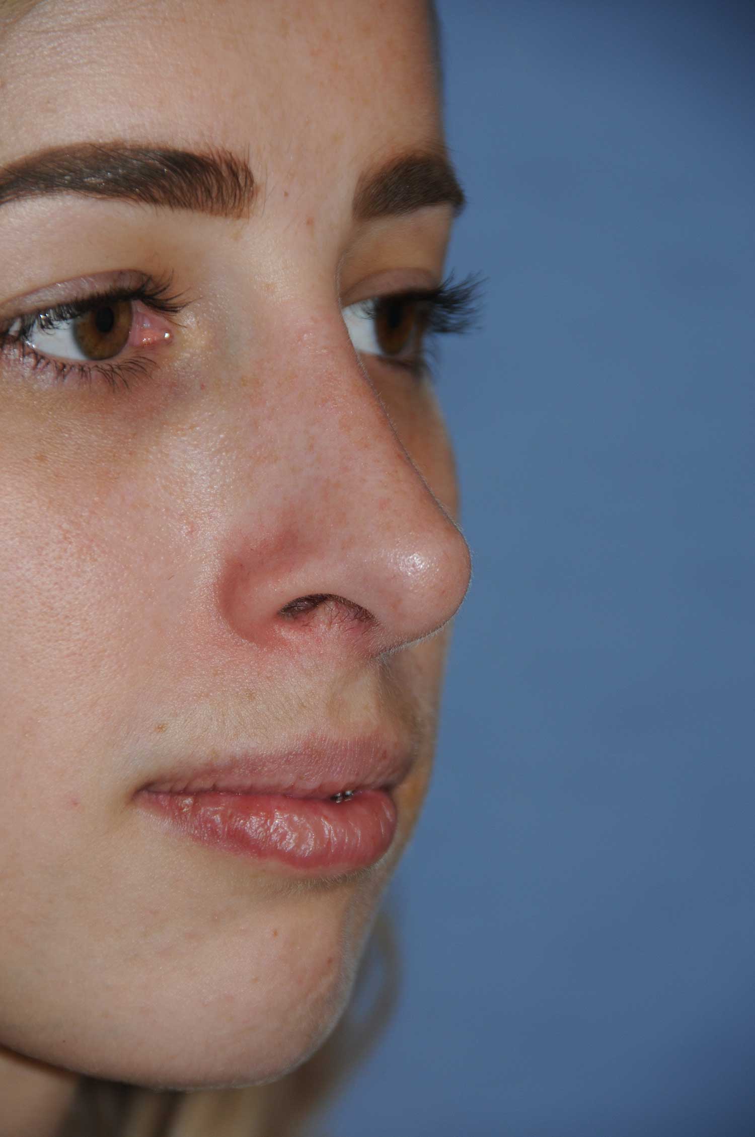 After Rhinoplasty for a Nasal Bridge Hump Bump, Large Hook Nose Right Oblique