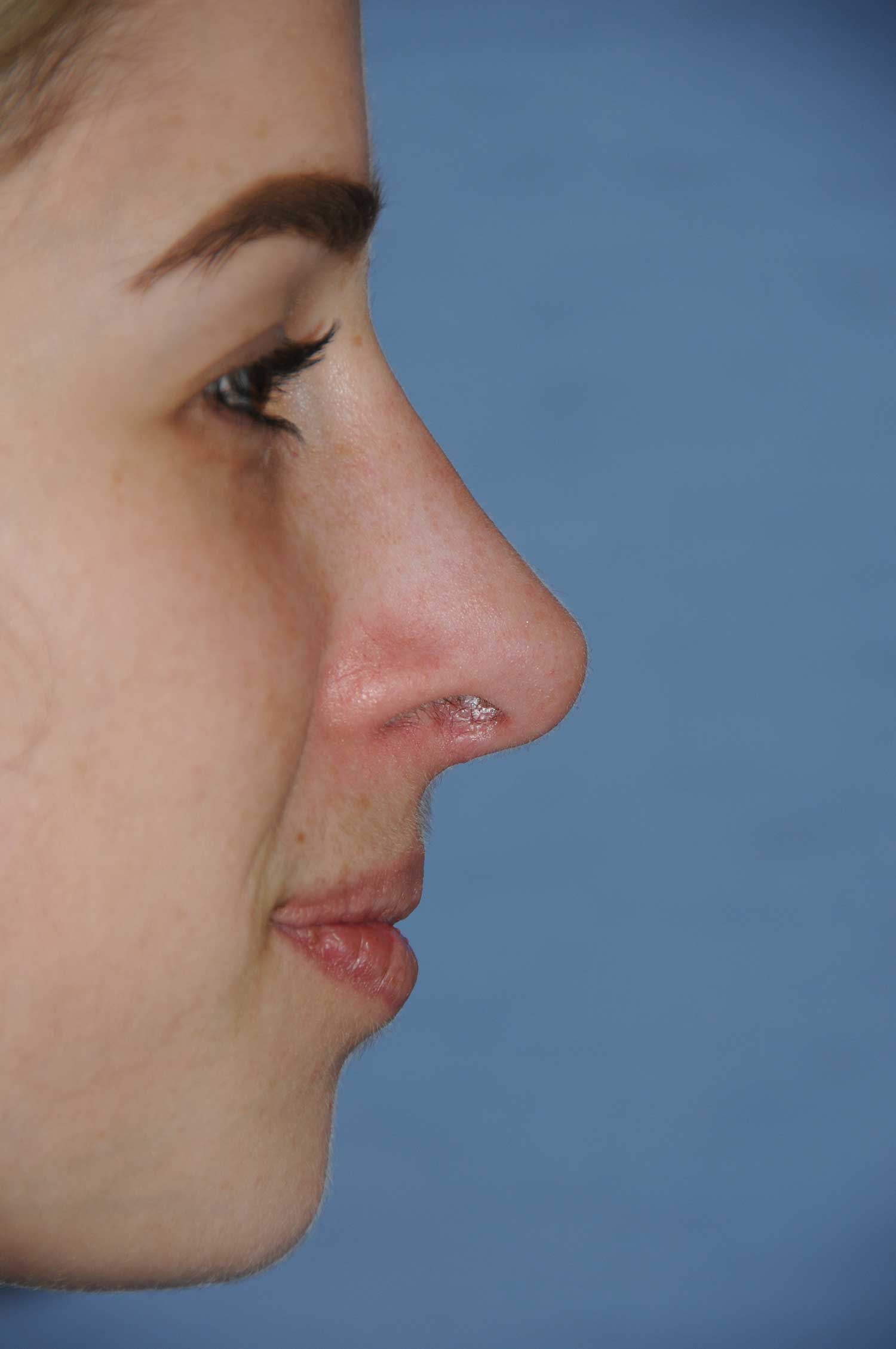 After Rhinoplasty for a Nasal Bridge Hump Bump, Large Hook Nose