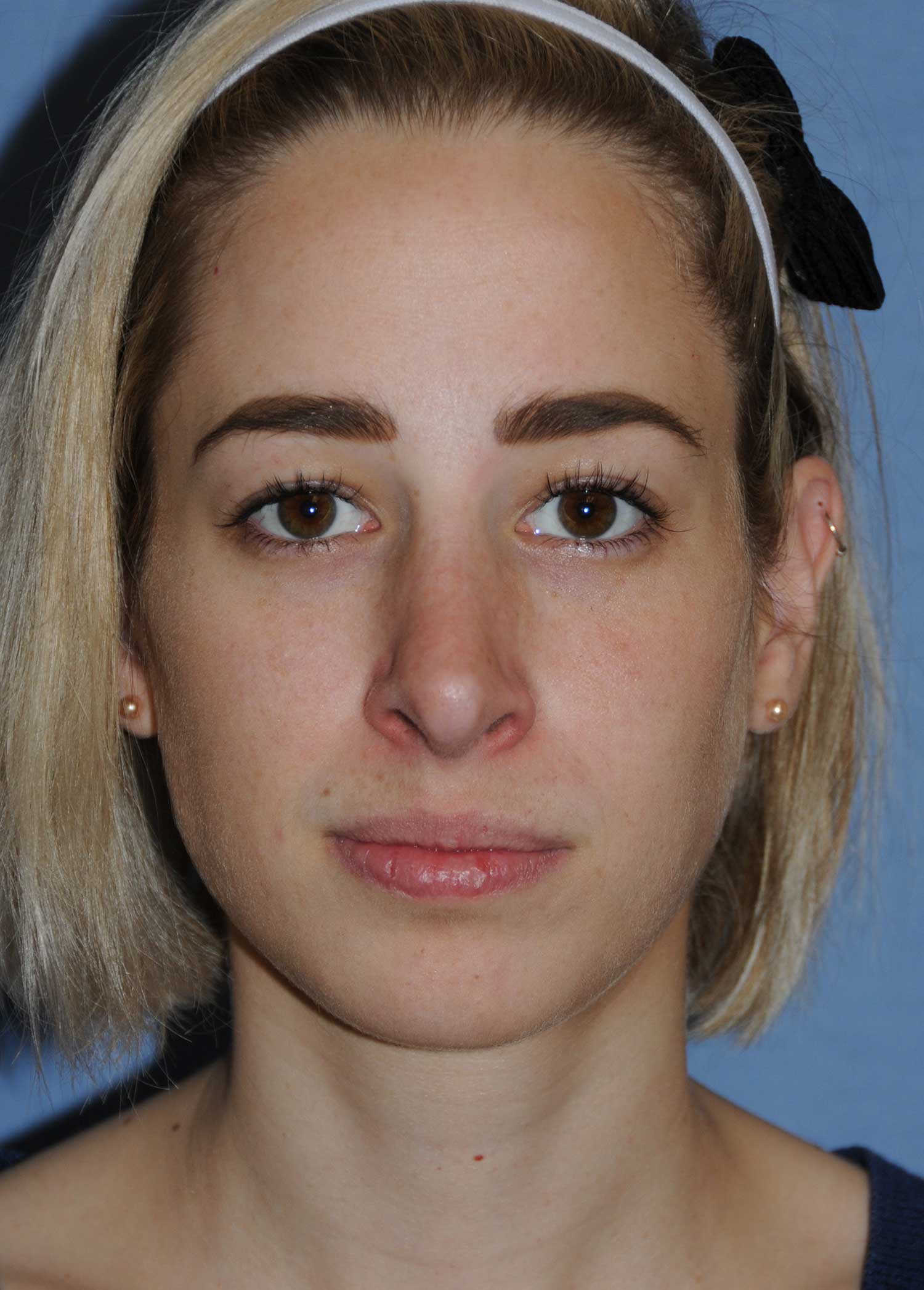 After Rhinoplasty for a Nasal Bridge Hump Bump, Large Hook Nose