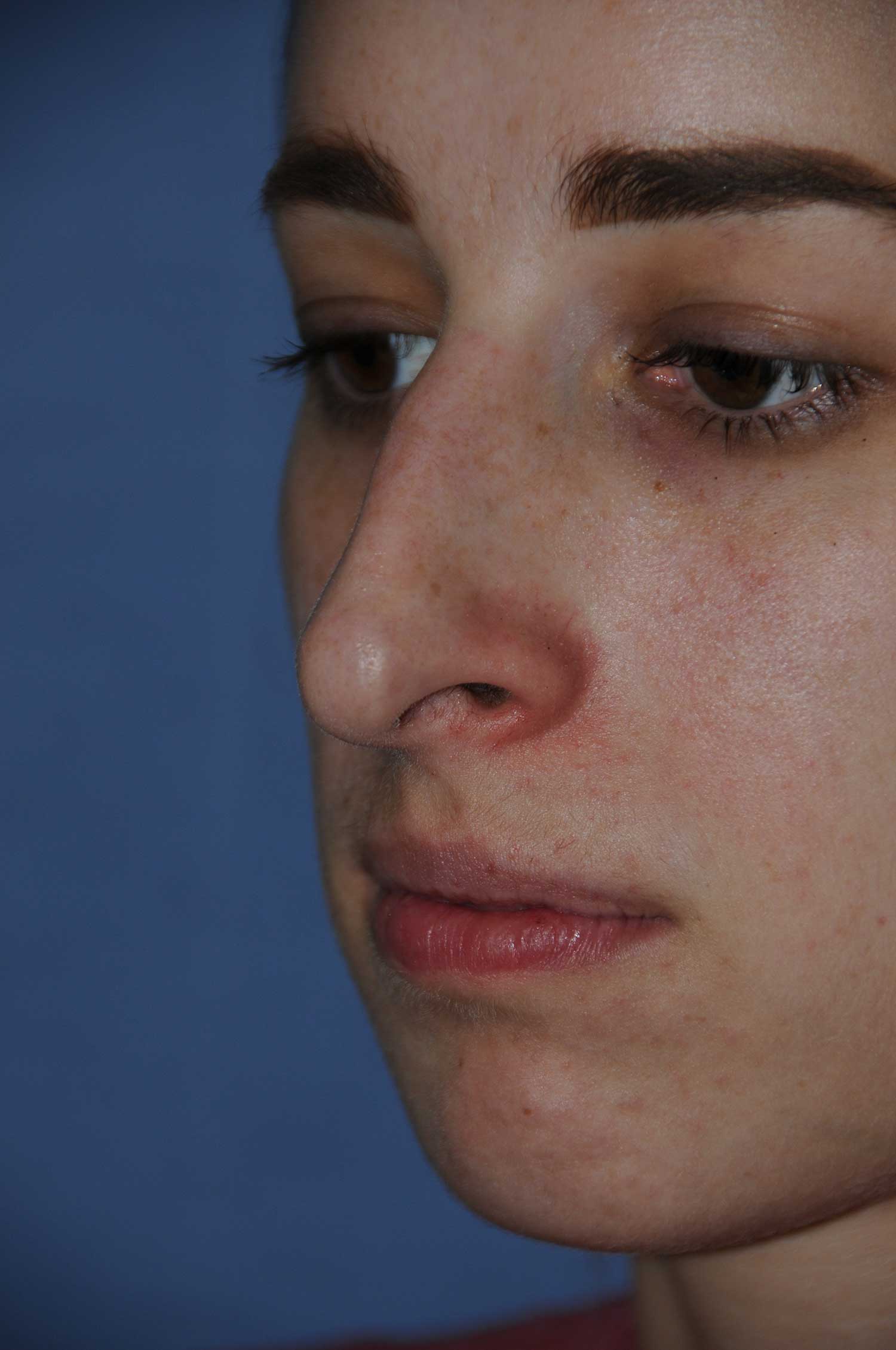Before Rhinoplasty for a Nasal Bridge Hump Bump, Large Hook Nose Left Oblique