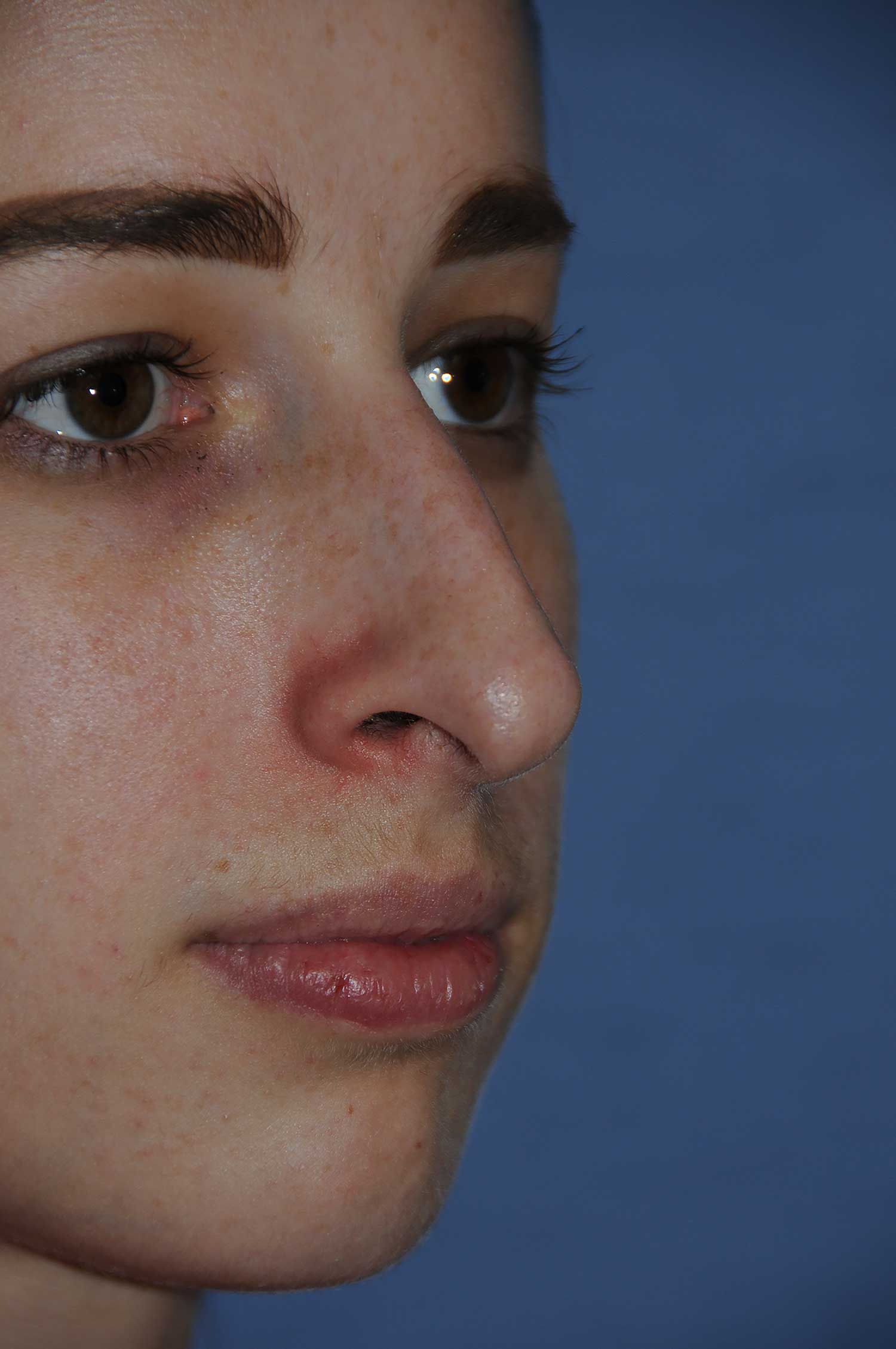 Before Rhinoplasty for a Nasal Bridge Hump Bump, Large Hook Nose Right Oblique