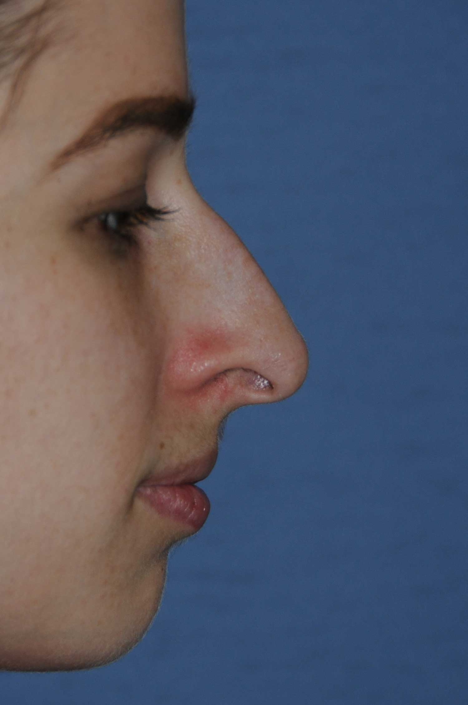Before Rhinoplasty for a Nasal Bridge Hump Bump, Large Hook Nose