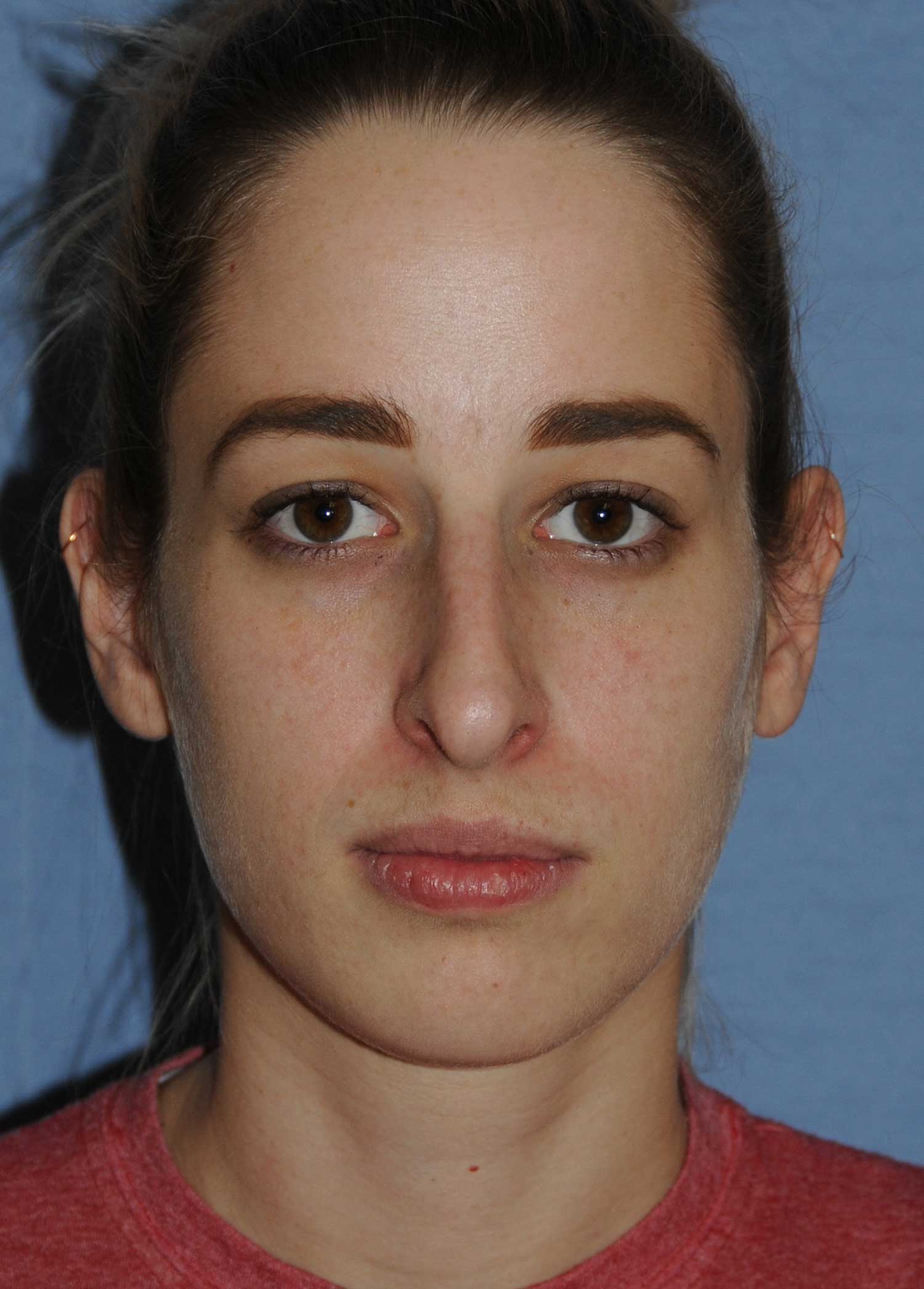 Before Rhinoplasty for a Nasal Bridge Hump Bump, Large Hook Nose