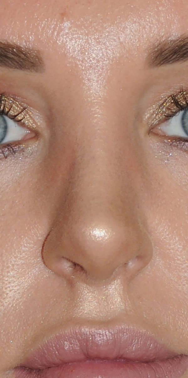 Rhinoplasty for this Overly Projected, Nasal Tip and Bridge, Large Nose, and Bulbous Nasal Tip After View