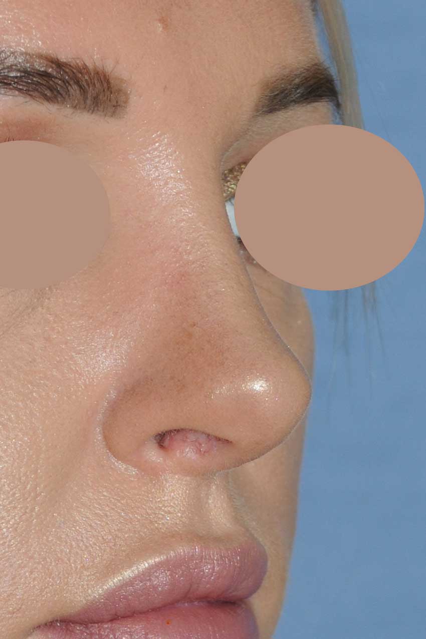 Rhinoplasty for this Overly Projected, Nasal Tip and Bridge, Large Nose, and Bulbous Nasal Tip After Right Oblique View