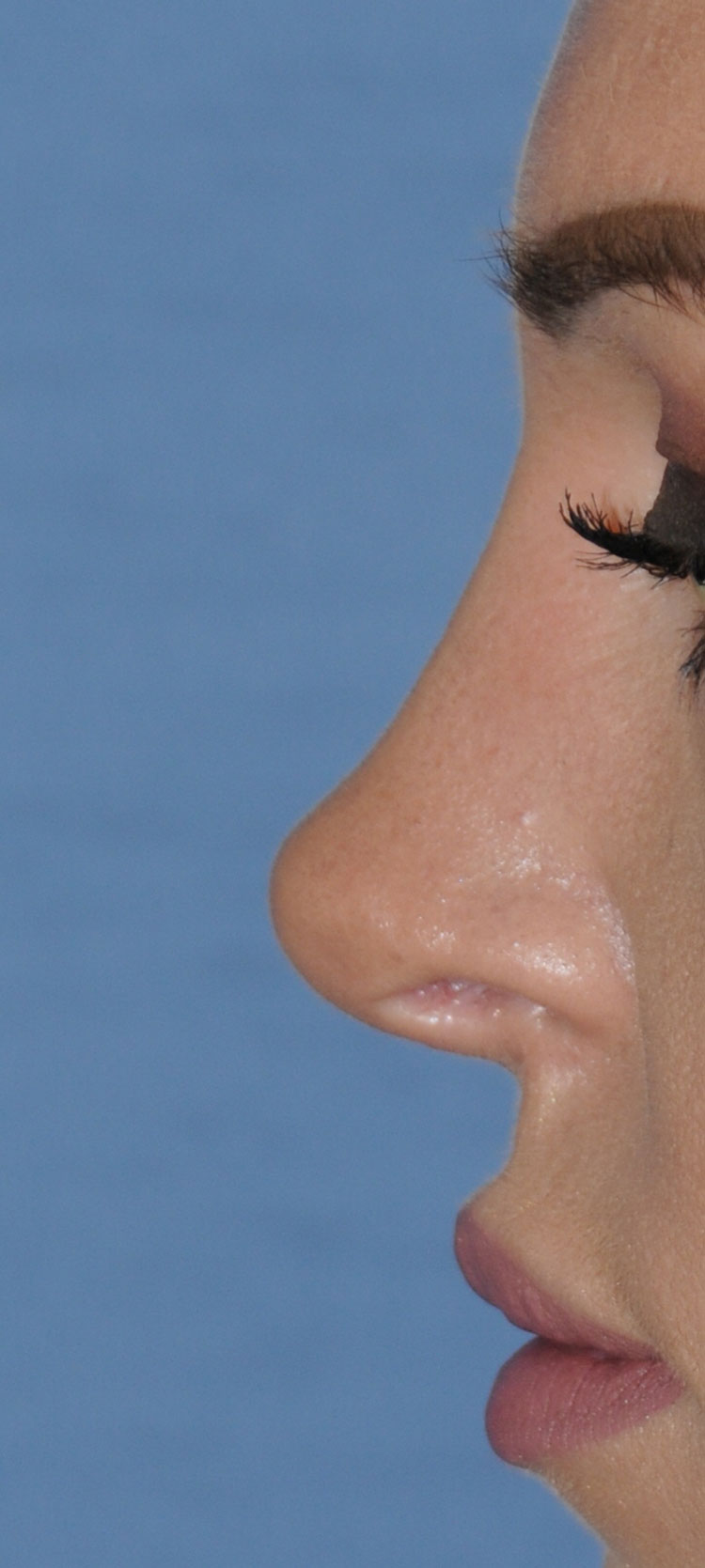 Rhinoplasty for this Overly Projected, Nasal Tip and Bridge, Large Nose, and Bulbous Nasal Tip After Side Profile View