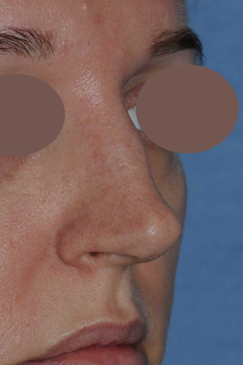Rhinoplasty for this Overly Projected, Nasal Tip and Bridge, Large Nose, and Bulbous Nasal Tip Before Right Oblique View